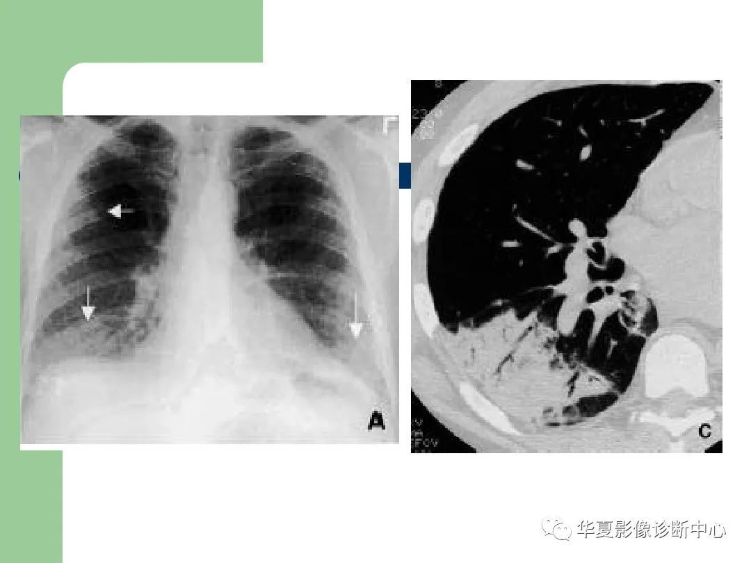 特发性间质性肺炎影像诊断