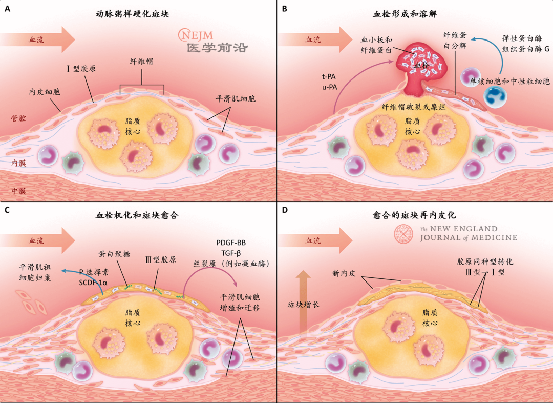 新英格兰医学杂志综述动脉粥样硬化斑块