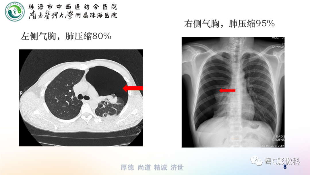 气胸胸腔积液肋骨骨折影像表现