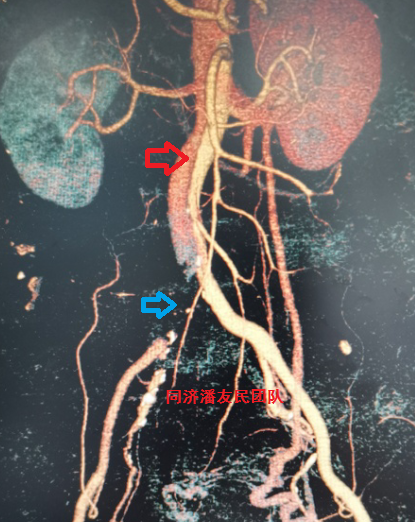 cta显示降主动脉夹层(红箭头所示)及右髂总动脉闭塞(蓝箭头所示)