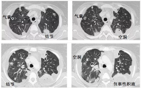 双肺多发的各种各样的病灶——气囊,结节,空洞,包裹性积液,一时间还真