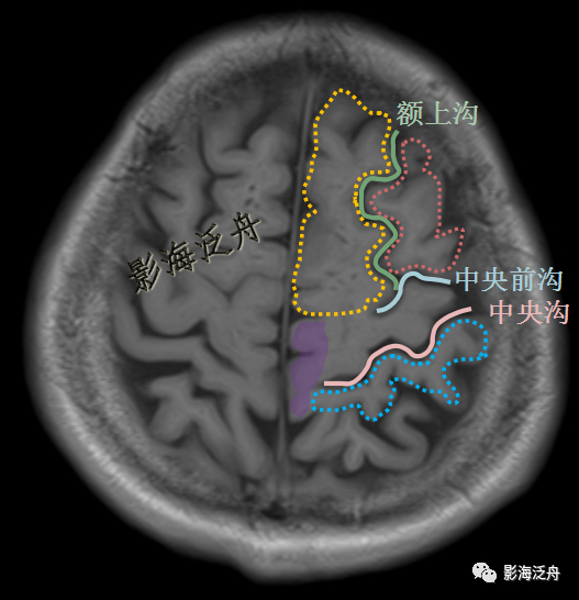 史上最详细的头颅mr解剖之额,顶,枕叶的脑沟,脑回定位_医学界-助力