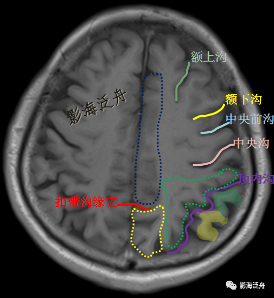 史上最详细的头颅mr解剖之额,顶,枕叶的脑沟,脑回定位_医学界-助力