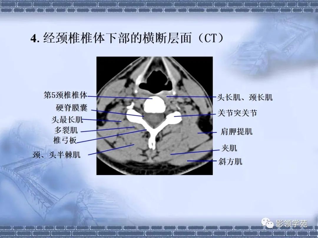 一文总结颈椎腰椎ct常见病变