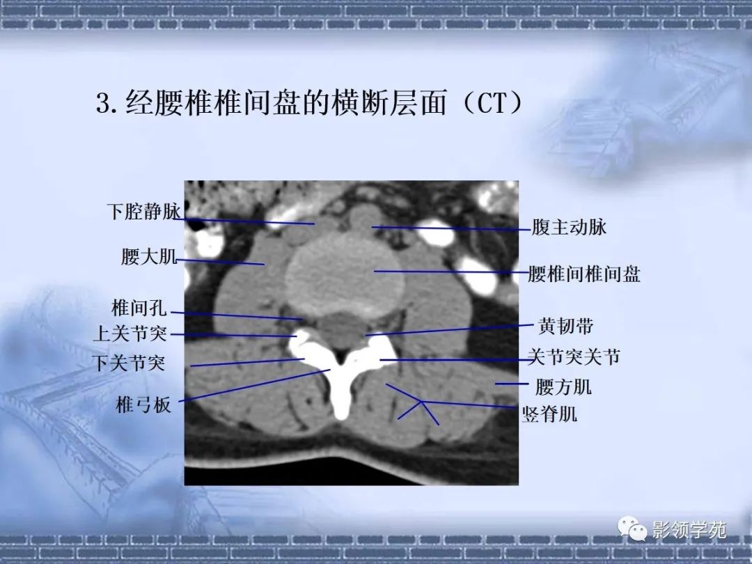 一文总结颈椎腰椎ct常见病变