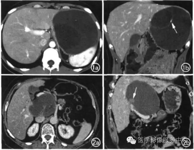a 横断面增强ct 扫描 b 冠状面增强ct 示肝左叶多房囊性肿物 约