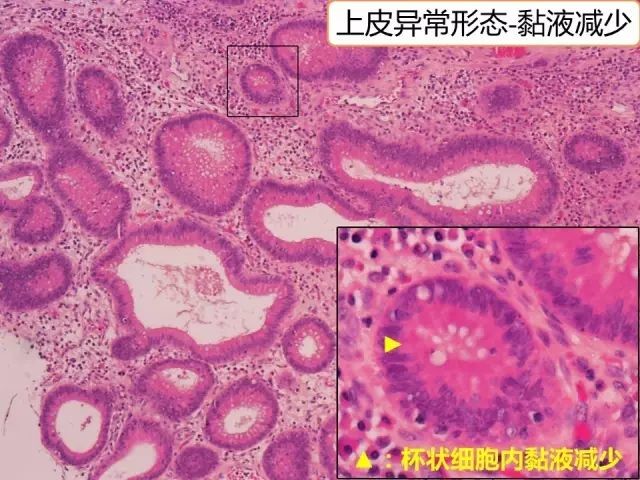 炎性浸润的形态学改变◆隐窝炎(cryptitis:中性粒细胞出现在隐窝上