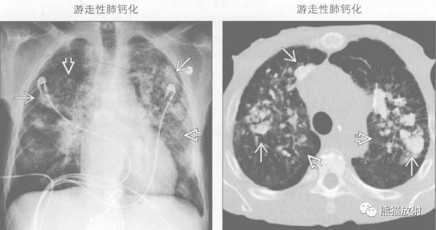 肺钙化的鉴别诊断