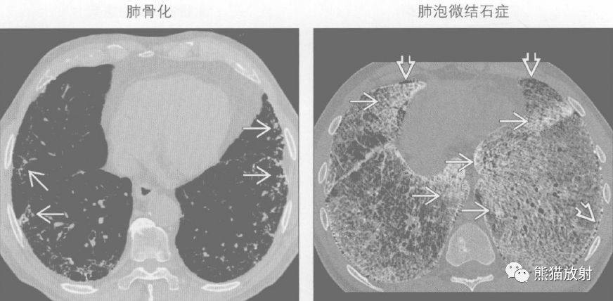 肺钙化的鉴别诊断