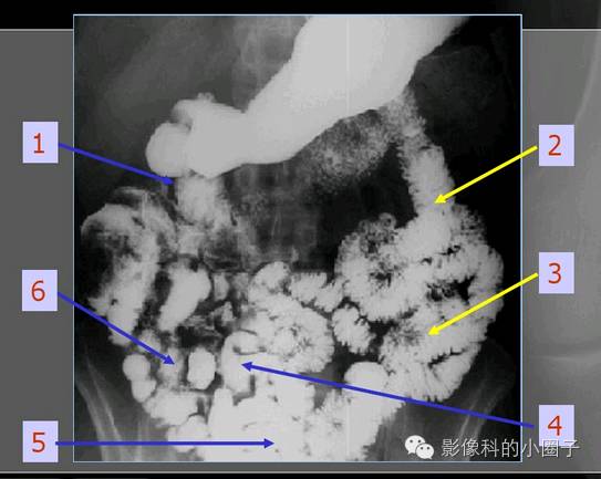 空肠降部,水平部,升部:黏膜皱襞呈羽毛状,与空肠