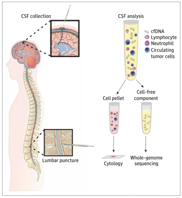 基于脑脊液cfdna检测诊断转移软脑膜病比细胞学方法有效