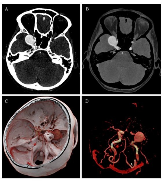 颅内动脉瘤和血管造影阴性蛛网膜下腔出血的影像学综述_医学界-助力