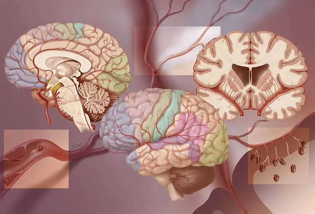 脑卒中，3种康复疗法了解一下？_医学界-助力医生临床决策和职业成长