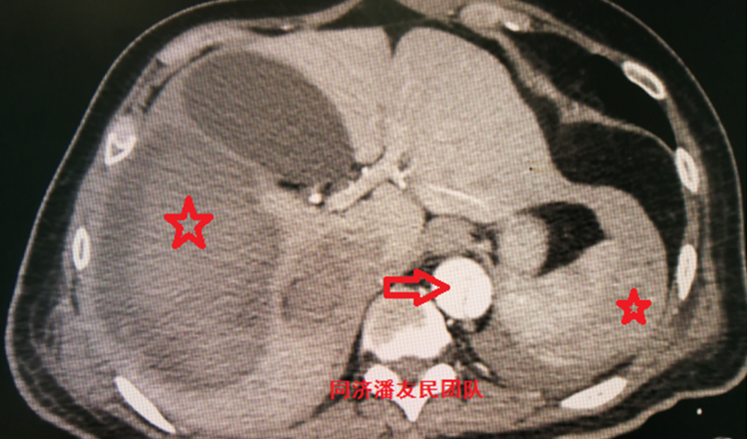 这类主动脉夹层死亡率高,极易漏诊,误诊!