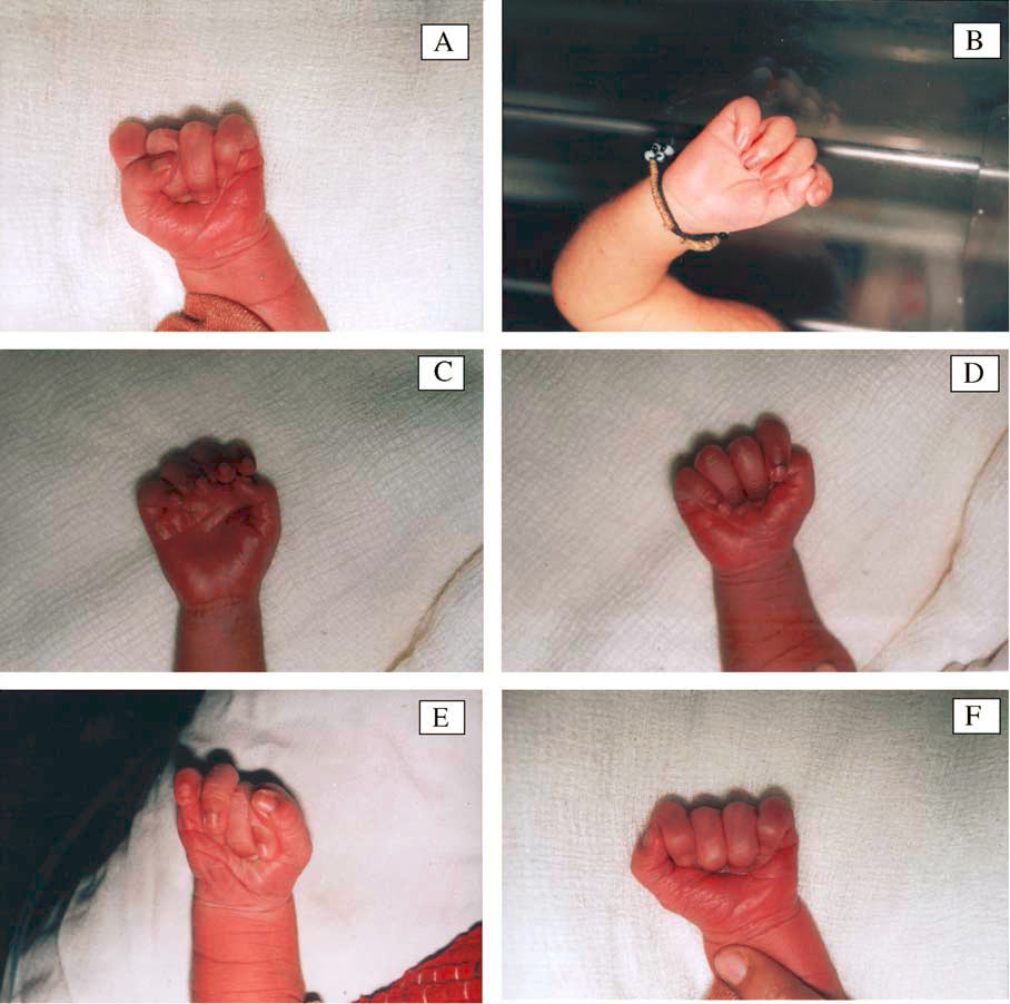 宝宝大拇指握在手掌里,几月才考虑脑瘫?什么情况要做手术?