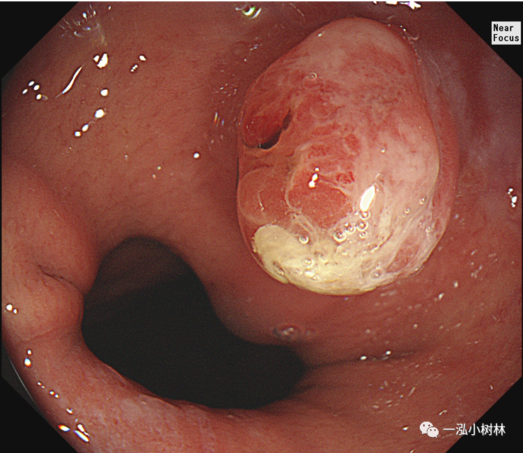 胃窦息肉图片图片