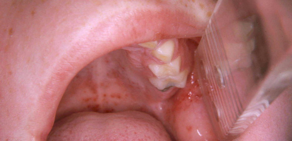 口腔增生性红斑图片图片