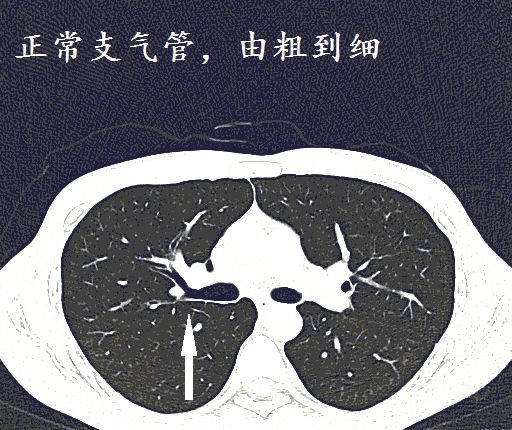 经典图谱详细解说支气管扩张ct小诀窍