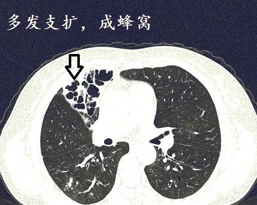 支气管囊肿ct表现图片图片