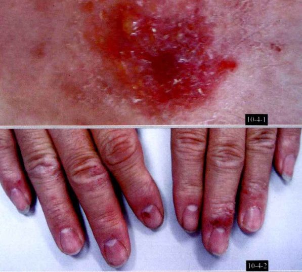 临床82 种常见皮肤病诊断及用药(附图谱)_医学界-助力医生临床决策和