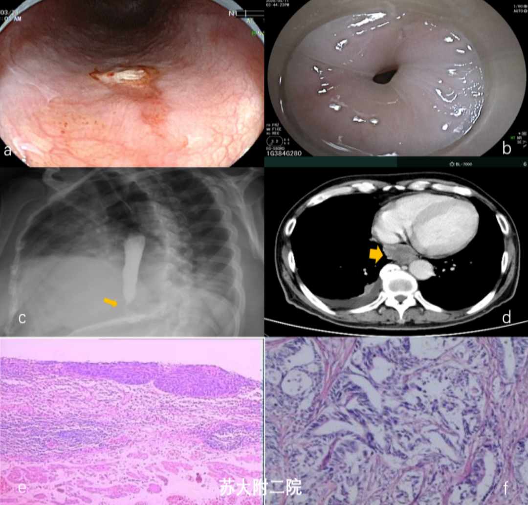 鳥嘴徵賁門失弛緩還可能是肝癌胃癌等惡性腫瘤