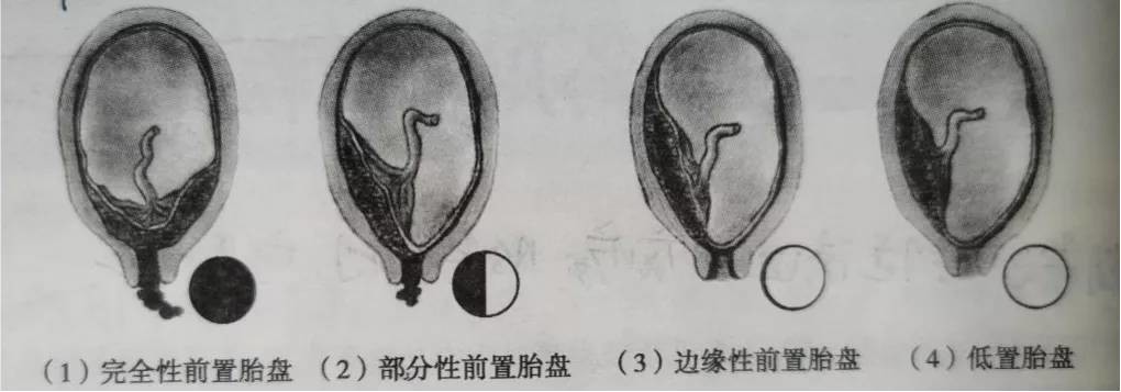 前置胎盘诊治指南究竟有哪些重点专家解读