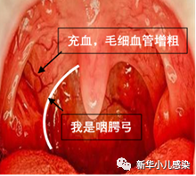 反复发热 扁桃体化脓 竟不用抗生素 医学界 助力医生临床决策和职业成长