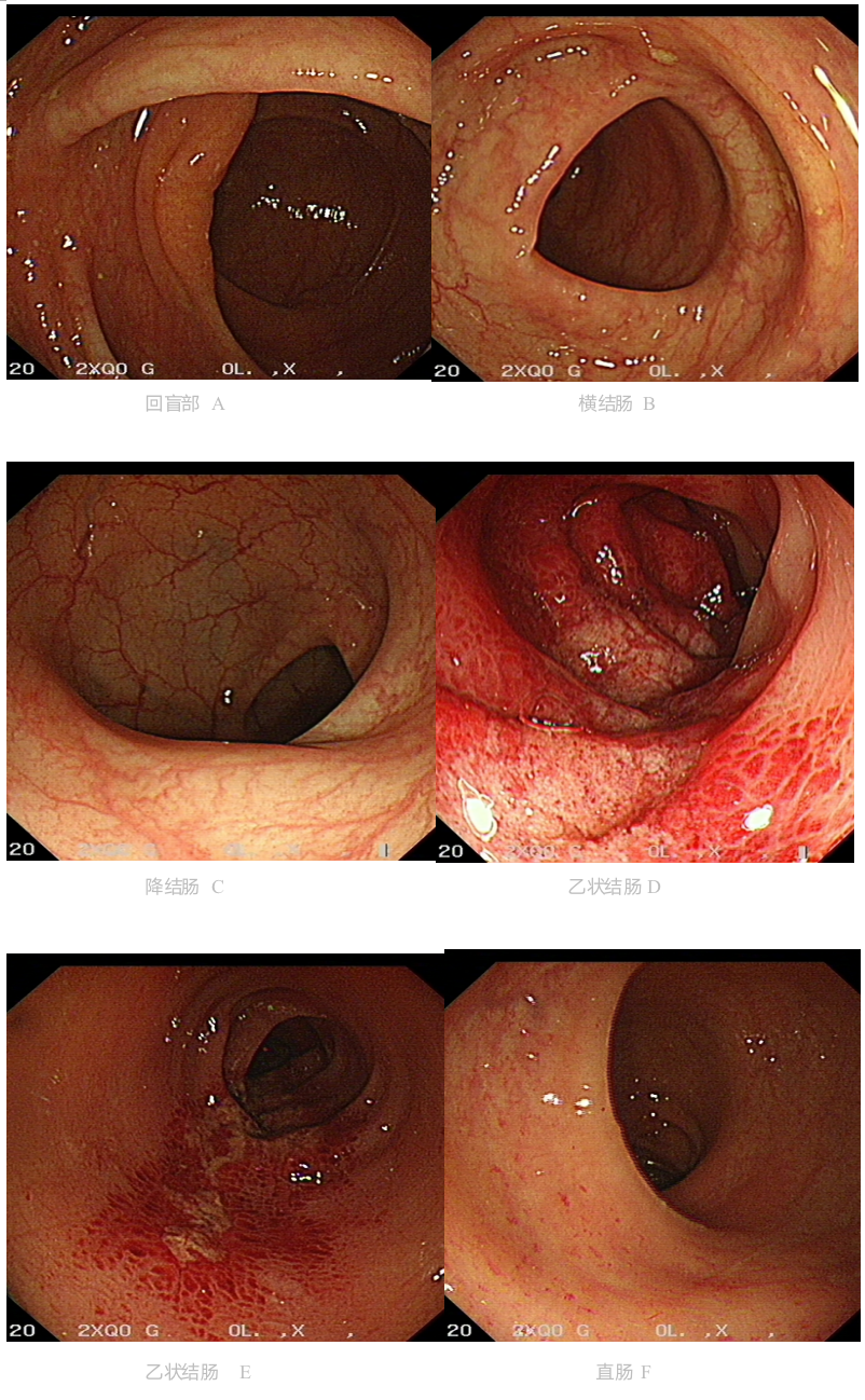 乙状结肠炎有什么症状图片