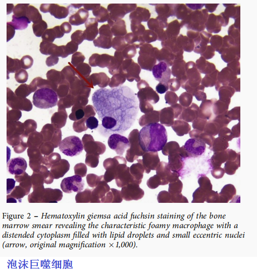 图4 镜下染色尼曼-匹克细胞形态图5 基因检测结果▎  诊断:成人起病
