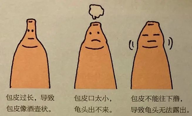包皮可以不割，但撸不能停？华西医生教你实战技巧！