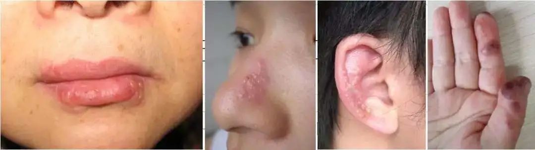 唇周长了小水泡 别总觉得是上火 医学界 助力医生临床决策和职业成长