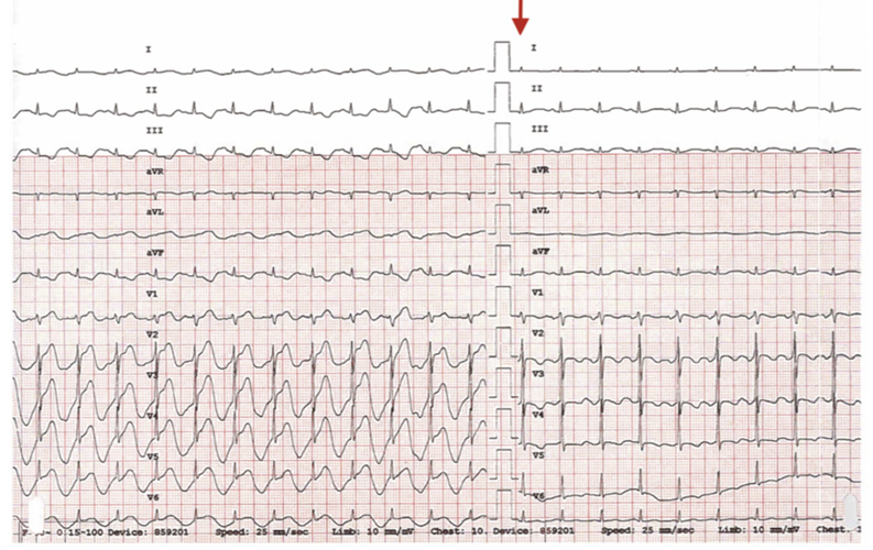 随后在上腹部按压或松手下行12导联心电图,也清楚地重现了这一动态