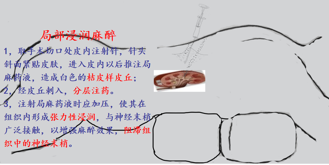 b超引导精准定位局部浸润麻醉下pcnl的应用体会