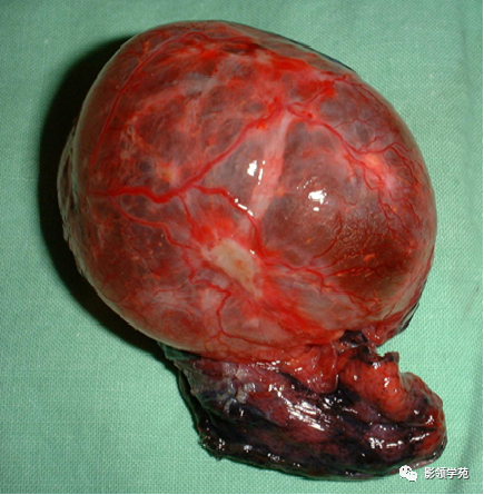 肺大泡影像学诊断及鉴别 医学界 助力医生临床决策和职业成长