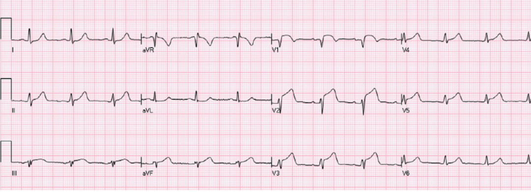 st段抬高不一定是心梗這8張心電圖必須鑑別