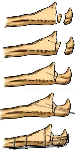 尺骨鹰嘴骨折手术步骤图片