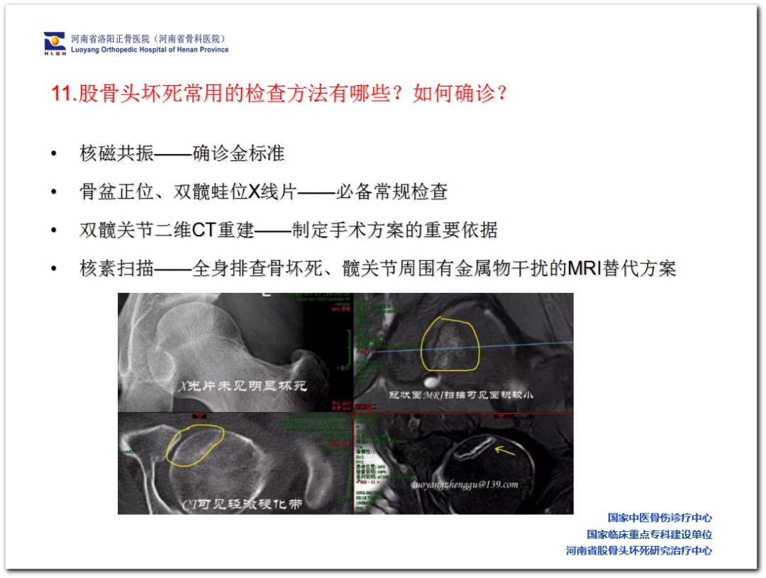 股骨头坏死双线征图片图片