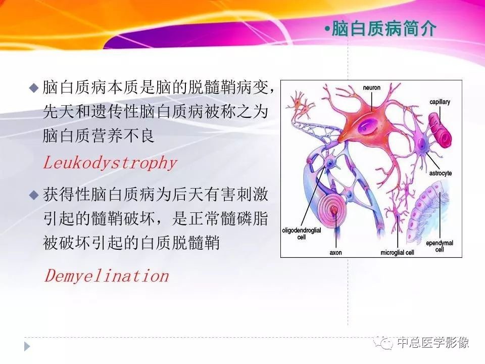 【临床＆影像】常见类型脑白质病