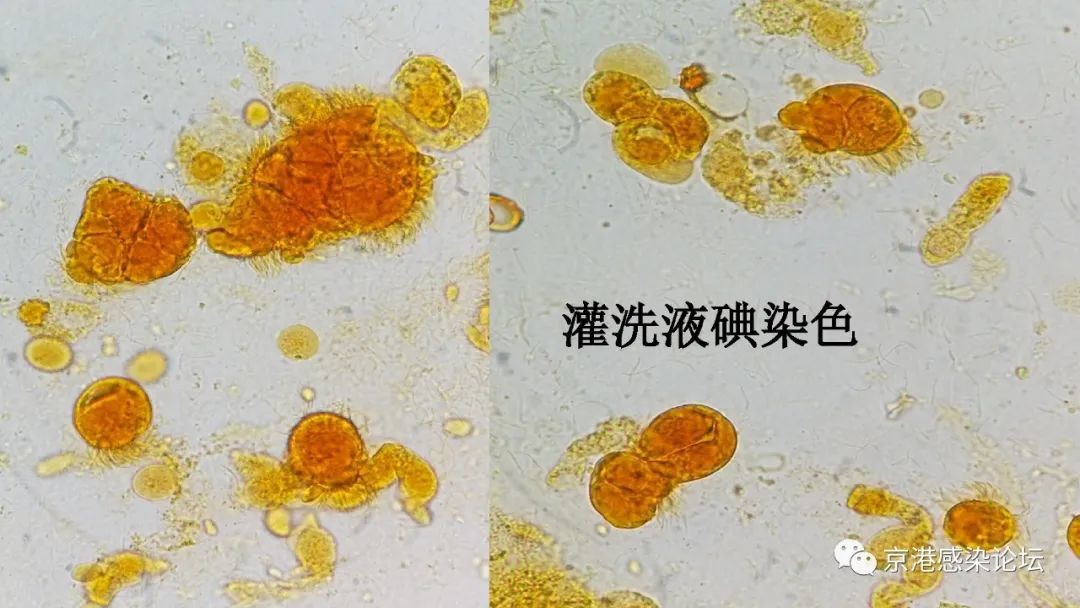【心得杂谈】 揭秘虫胞之争_医学界助力医生临床决策和职业成长