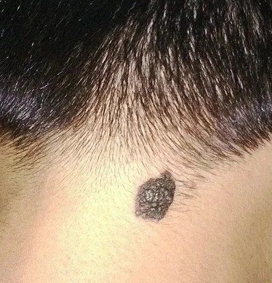 4,直径变大普通痣常年不会发生变化,一般小于5毫米;而恶性黑色素瘤会