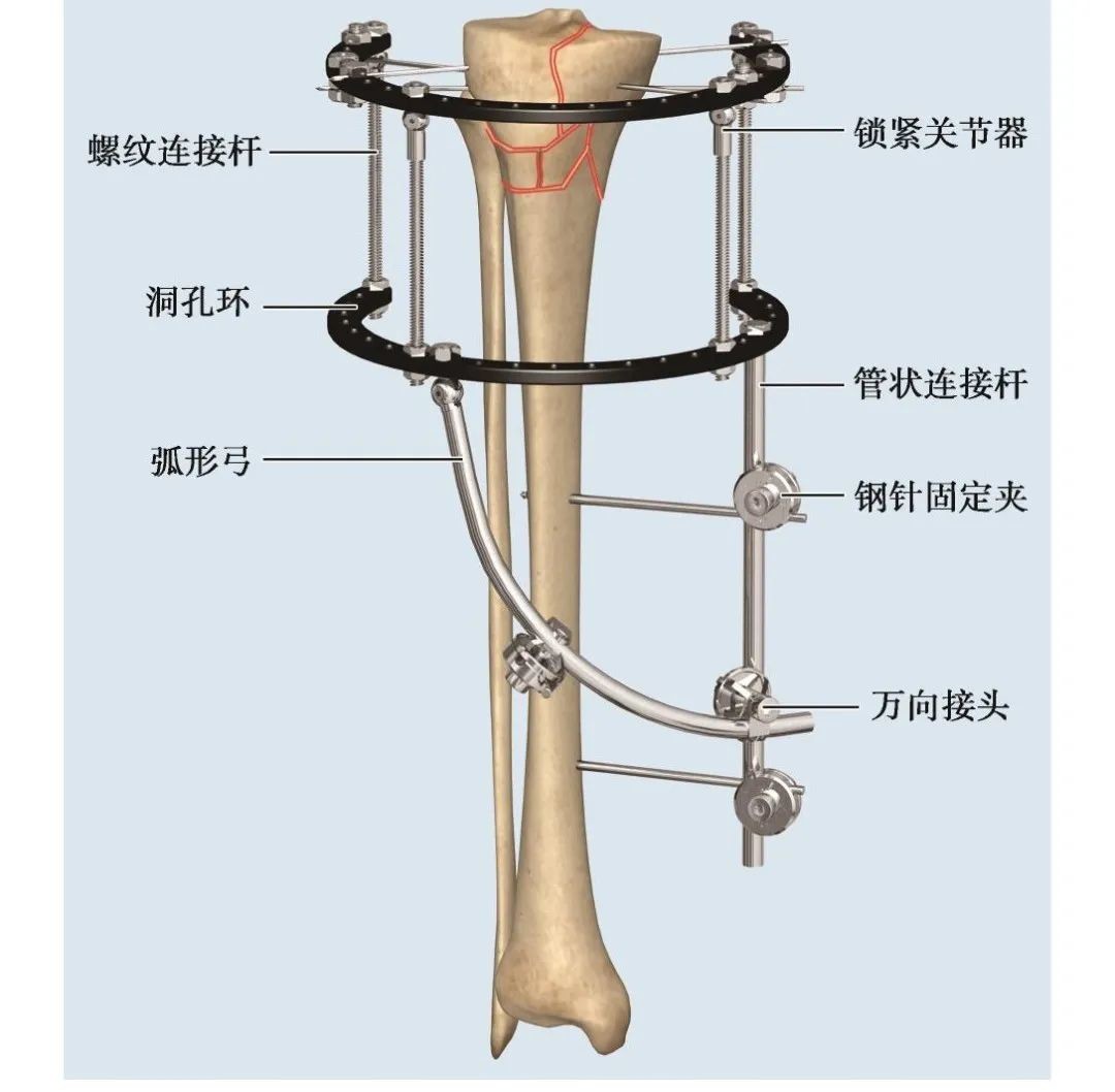 实用干货 膝关节外固定器使用技巧 医学界 助力医生临床决策和职业成长