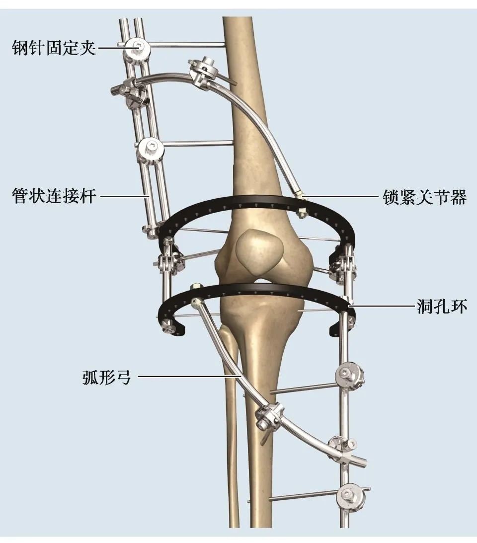 实用干货 膝关节外固定器使用技巧 医学界 助力医生临床决策和职业成长