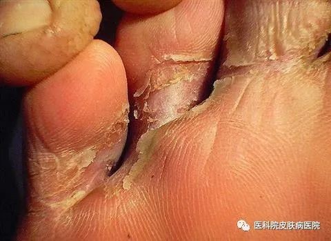 关于足癣 这是一条隔着屏幕就能闻出味道的科谱 医学界 助力医生临床决策和职业成长