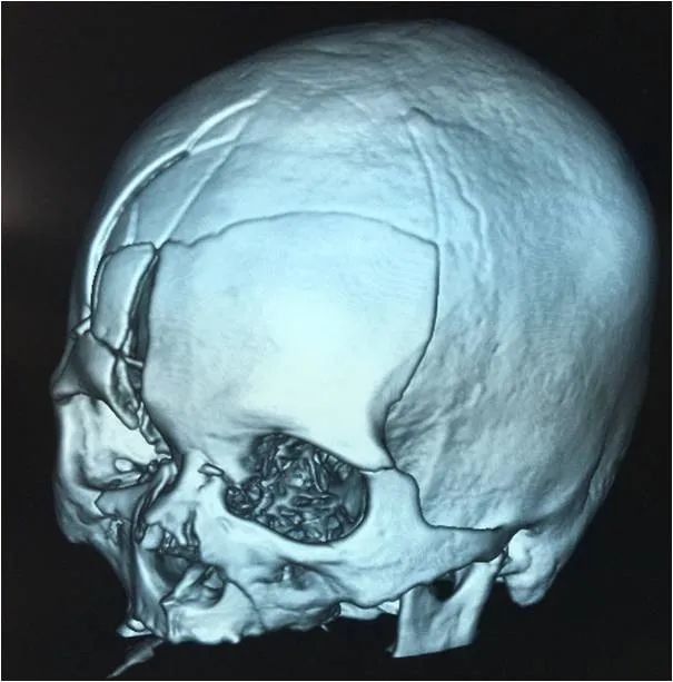 【病例】一例重型颅脑损伤的救治及经验_医学界-助力医生临床决策和