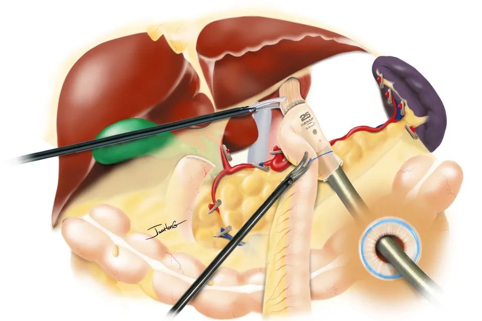 腹腔镜全胃切除术roux-en-y吻合 orvil吻合法_医学界-助力医生临床