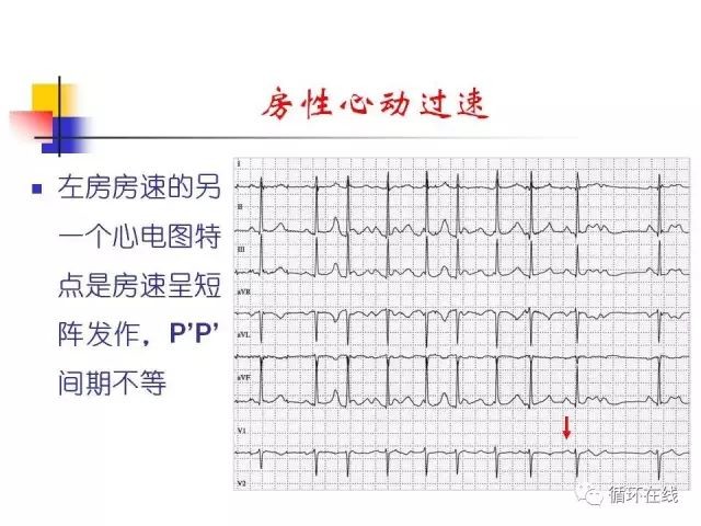房速与房扑的相关心电图问题（郭继鸿教授）