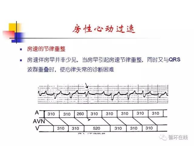 房速与房扑的相关心电图问题（郭继鸿教授）