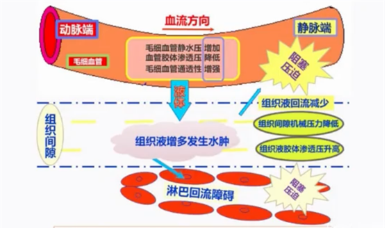 毛细血管血流动力学的改变(毛细血管内静水压增加,血浆胶体渗透压降低