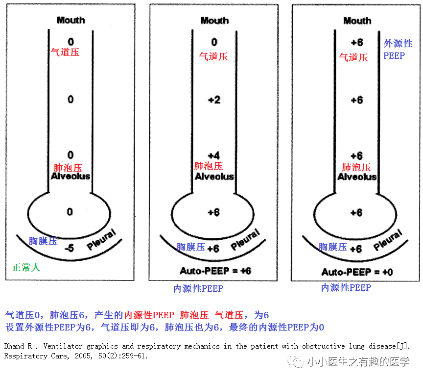 呼吸重症 气道阻塞性疾病的呼吸机波形 医学界 助力医生临床决策和职业成长