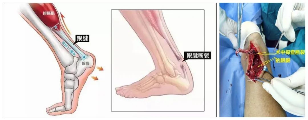 跟腱 阿喀琉斯之痛 为何如此强壮又如此脆弱 医学界 助力医生临床决策和职业成长 跟腱 阿喀琉斯之痛 为何如此强壮又如此脆弱 医学界 助力医生临床决策和职业成长